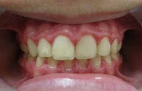 Traitement orthodontique d’une pro alveolie chez une enfant
