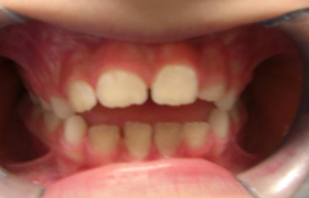 Traitement orthodontique d’une pro alveolie chez une enfant