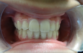Traitement d'orthodontie pour un décalage dentaire d'une jeune fille à Marseille.
