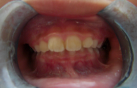Traitement d'orthodontie pour un décalage dentaire d'une jeune fille à Marseille.