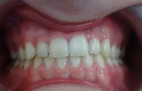 Traitement d'orthodontie sur un jeune adolescent de Septèmes les vallons